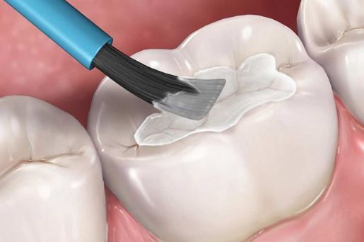 Trám Răng Thẩm Mỹ