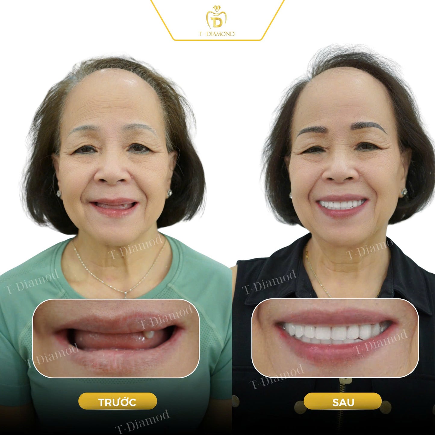 Complete removable denture