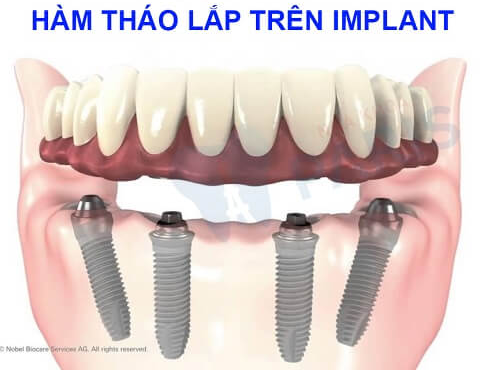 Removable dentures on Implant