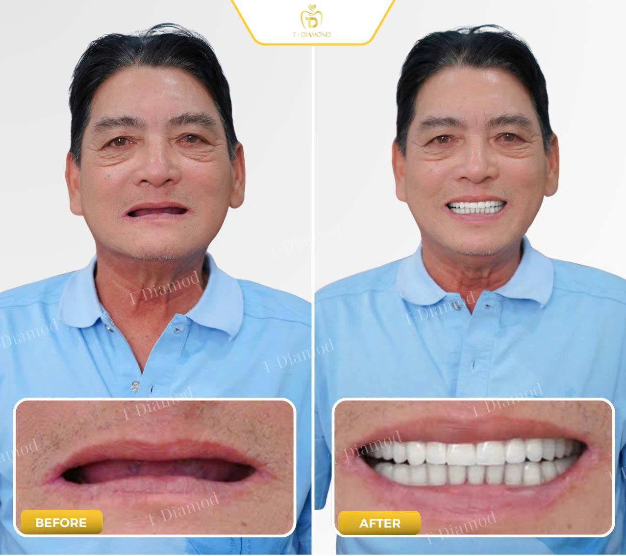 Complete removable denture