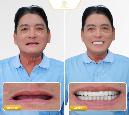 Complete removable denture