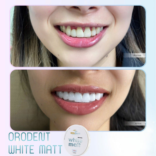 Răng Sứ Cao Cấp ORODENT