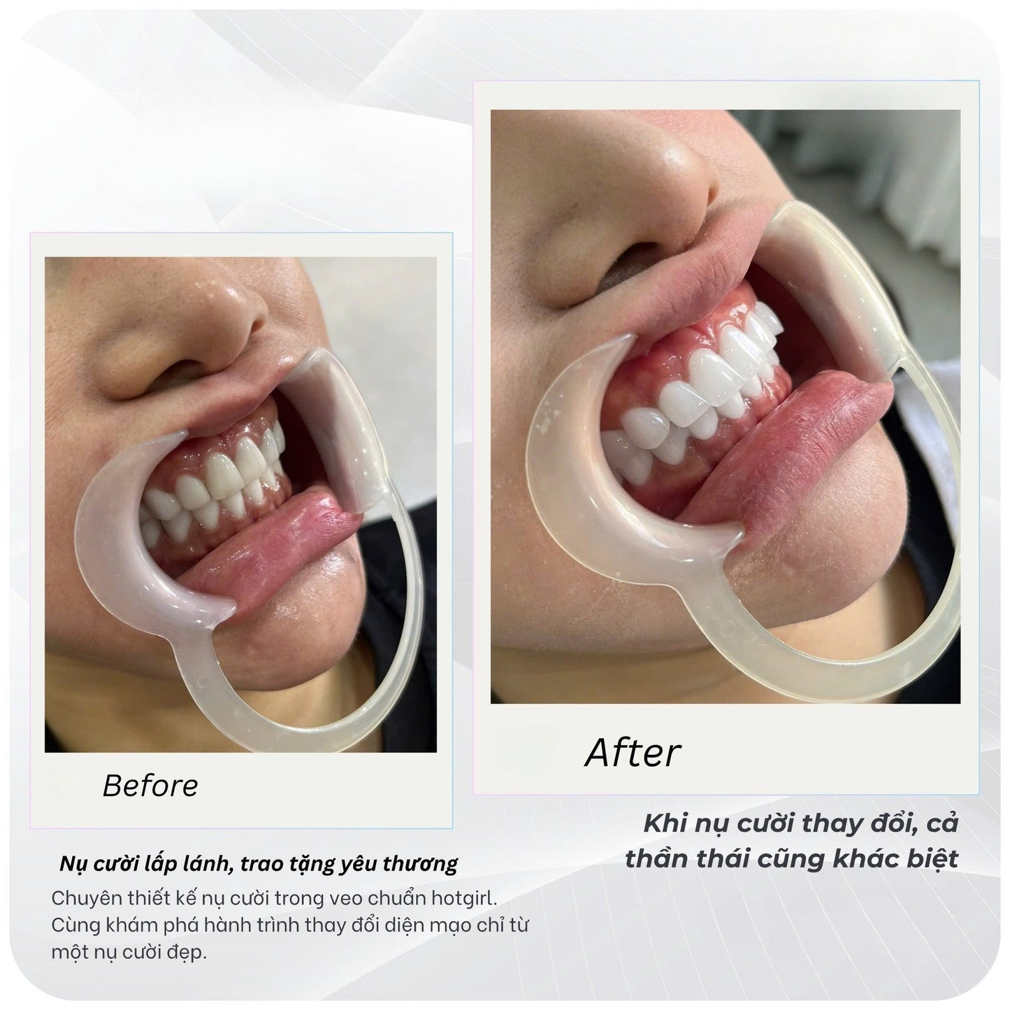 Cercon HT Porcelain Teeth