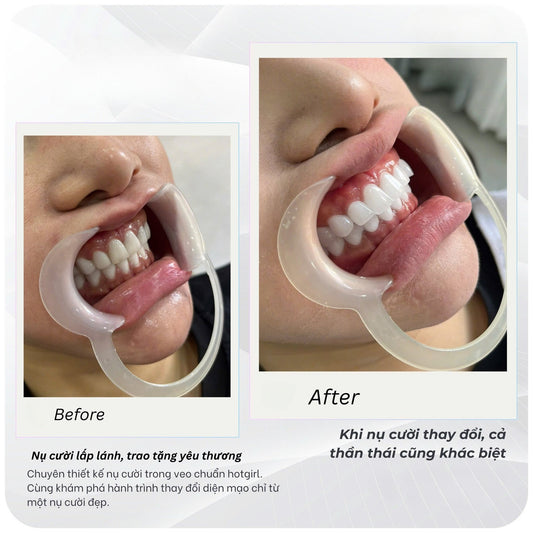 Cercon HT Porcelain Teeth