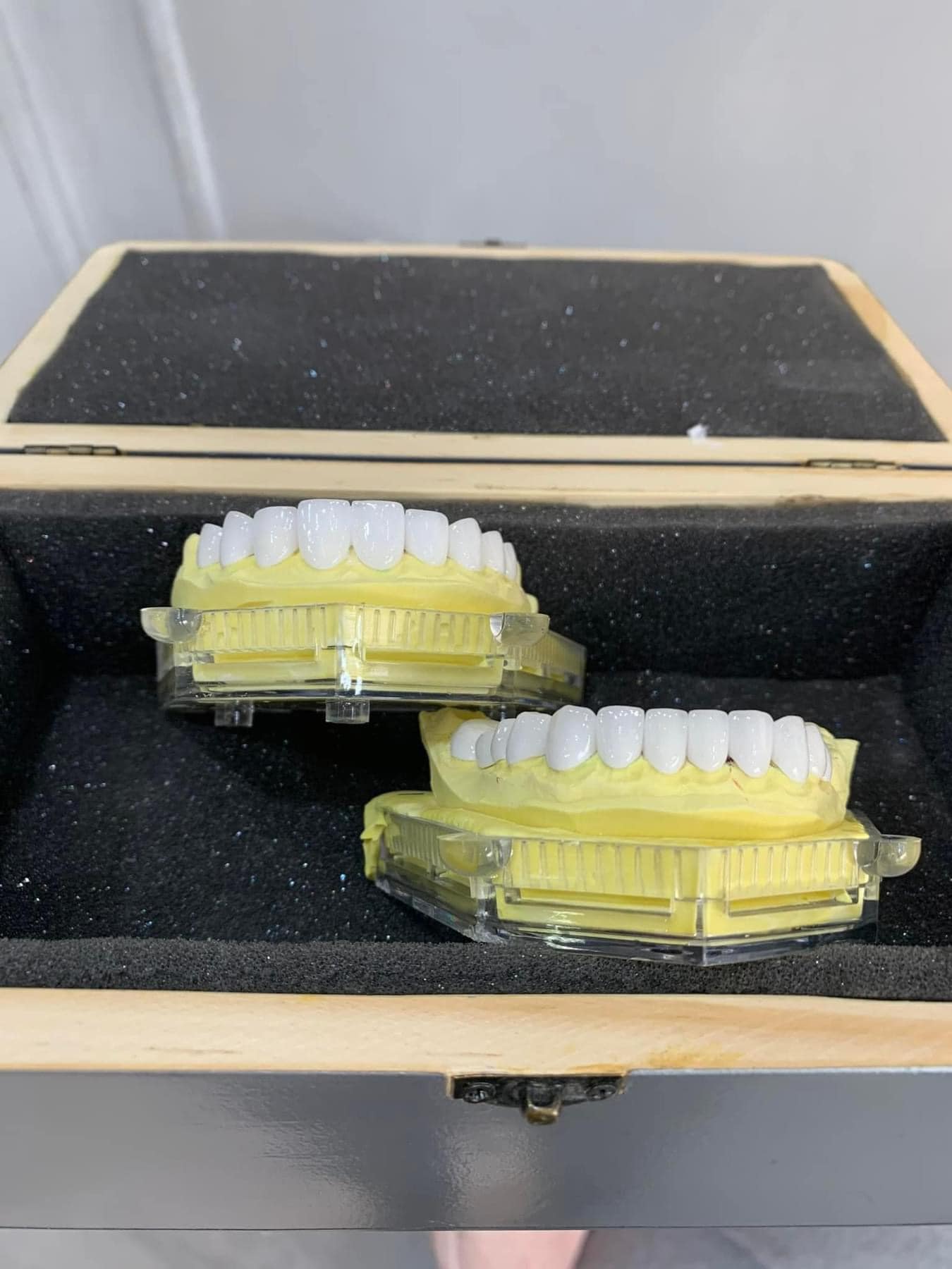 E-MAX Porcelain Veneers