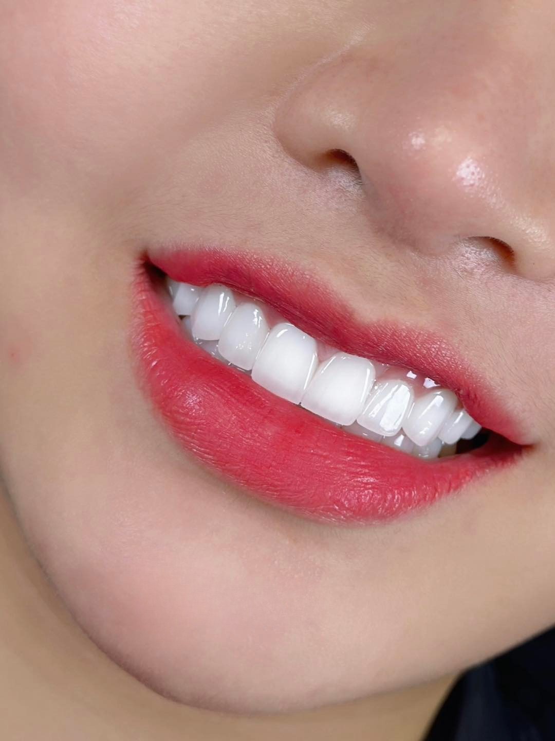 E-MAX Porcelain Veneers
