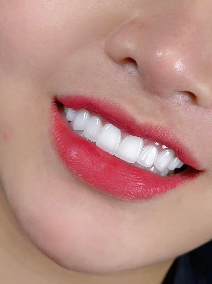 E-MAX Porcelain Veneers