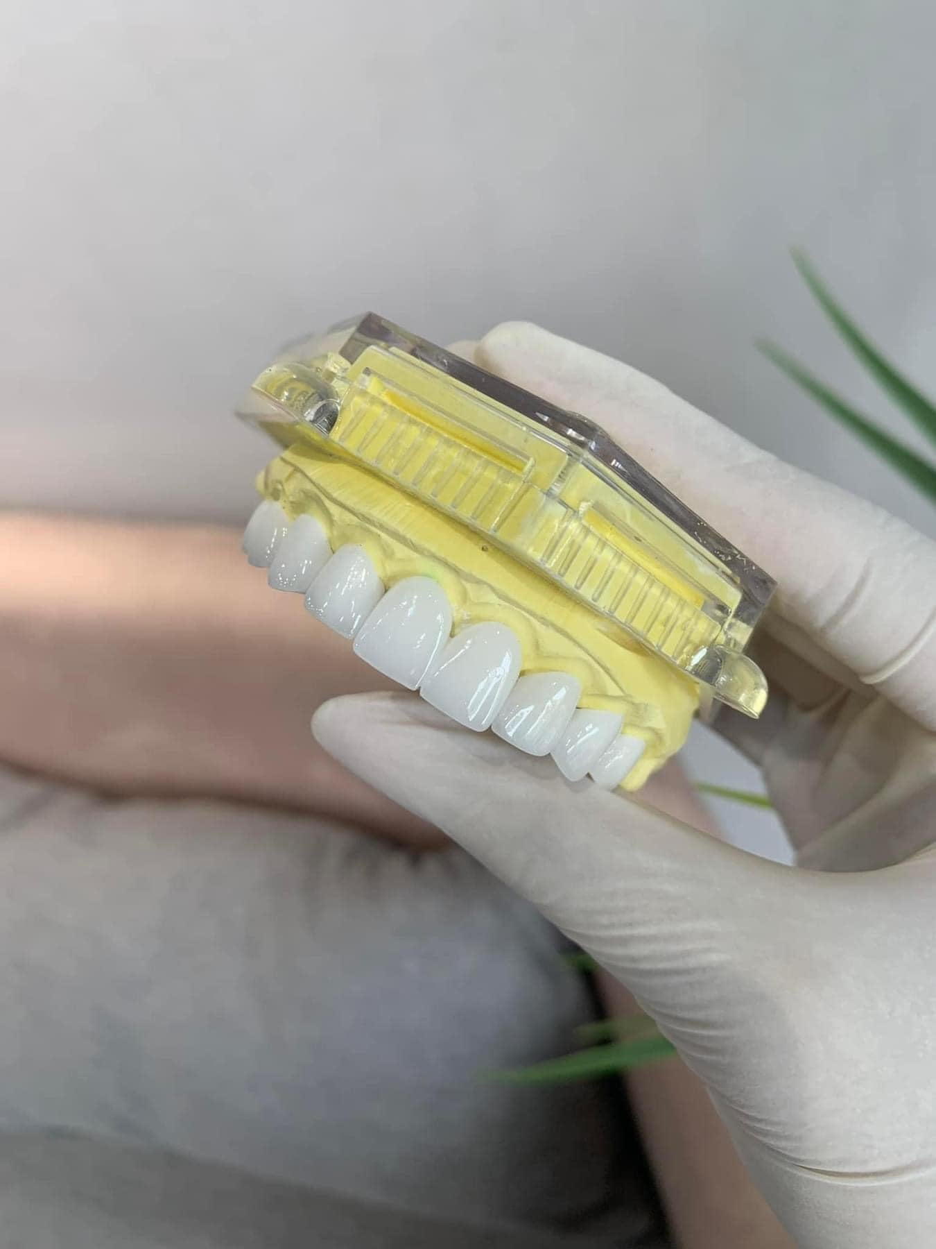 E-MAX Porcelain Veneers