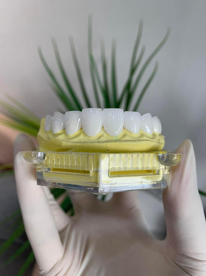 E-MAX Porcelain Veneers