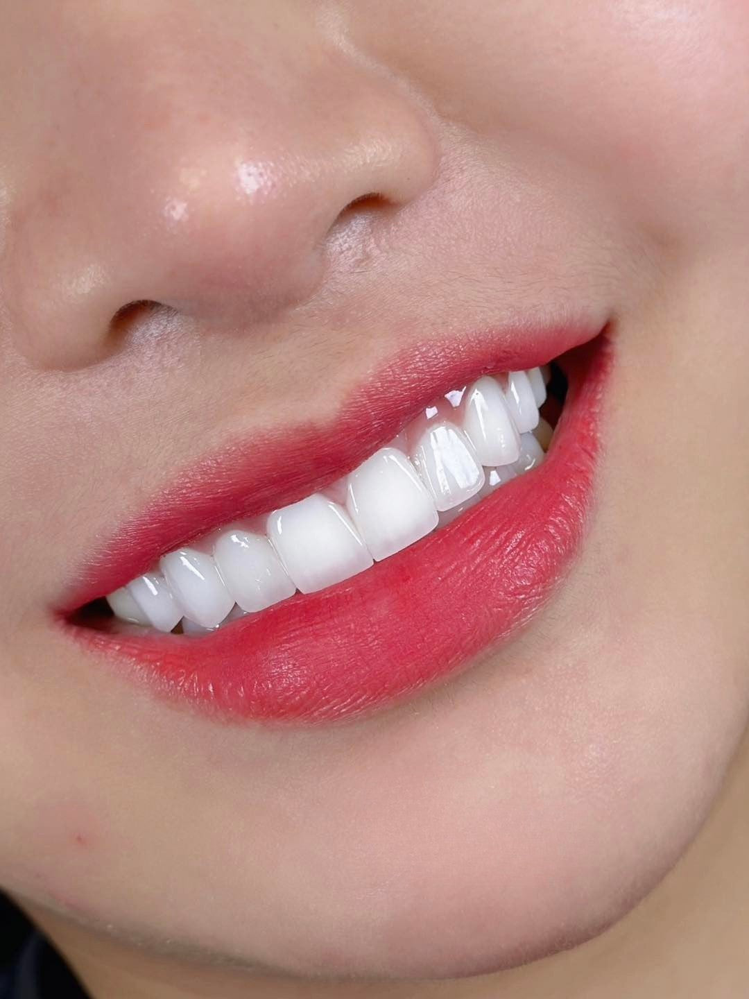 E-MAX Porcelain Veneers
