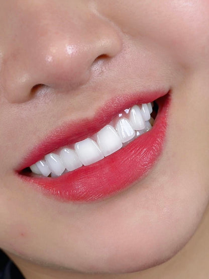 E-MAX Porcelain Veneers