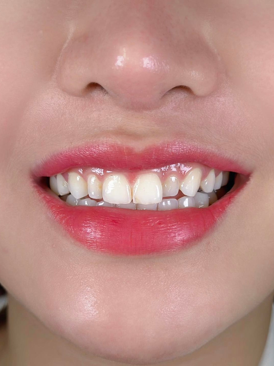 E-MAX Porcelain Veneers
