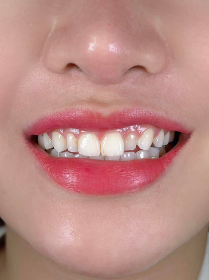 E-MAX Porcelain Veneers