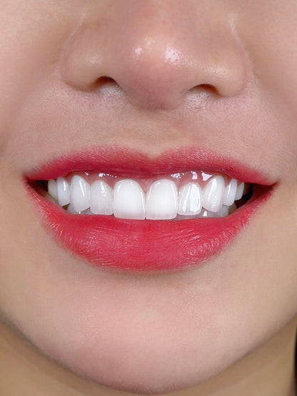 E-MAX Porcelain Veneers