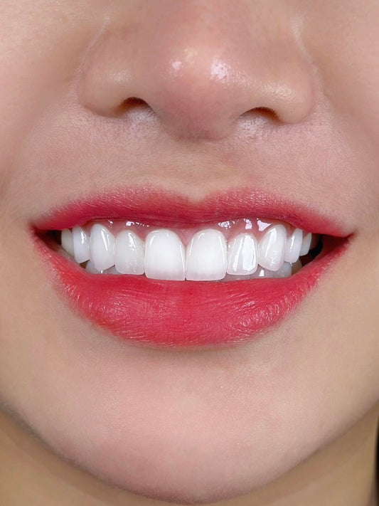 E-MAX Porcelain Veneers