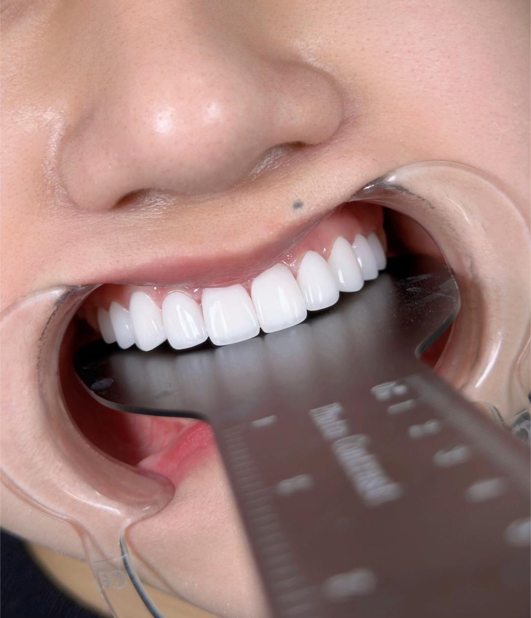 Răng Sứ Zirconia