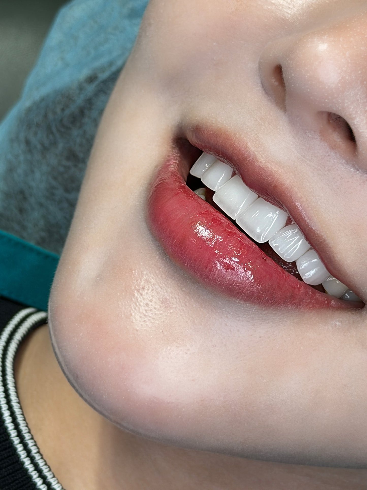 Răng Sứ Zirconia