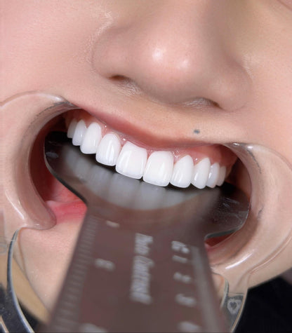 Răng Sứ Zirconia