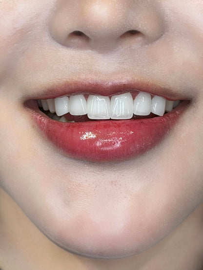 Răng Sứ Zirconia