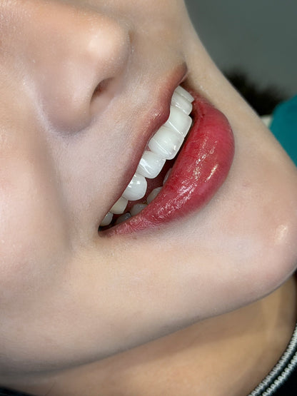Răng Sứ Zirconia