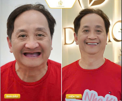 Complete removable denture