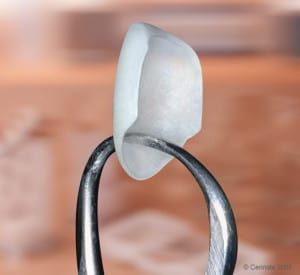 Porcelain Veneers