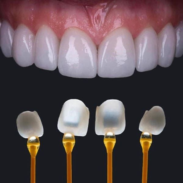 Porcelain Veneers