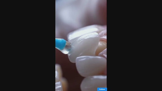 Porcelain Veneers