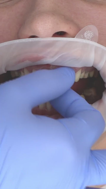 Porcelain Veneers