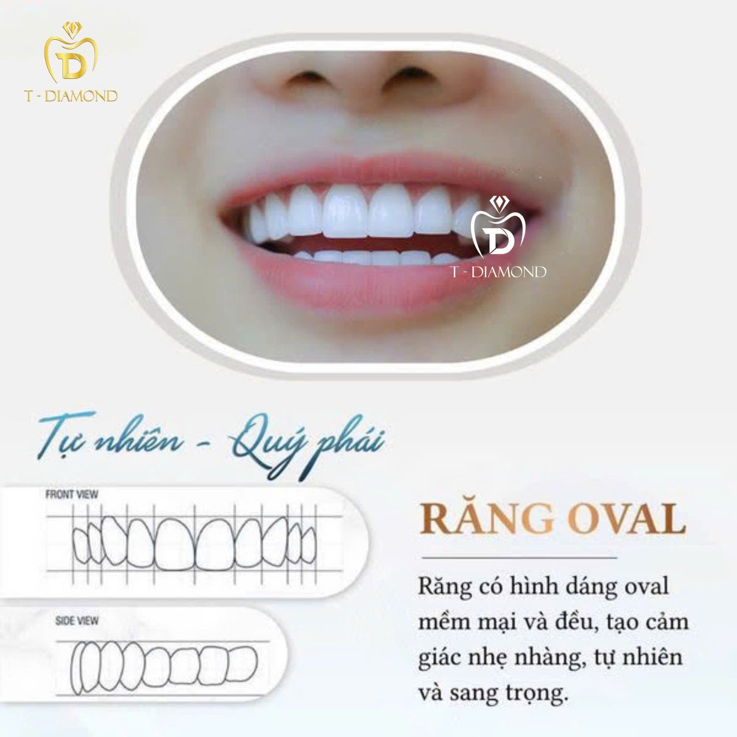 Cercon HT Porcelain Teeth